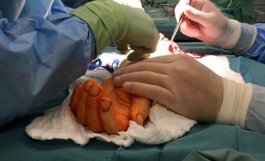 В Польше в первый раз пересадили руку человеку, рожденному без конечности