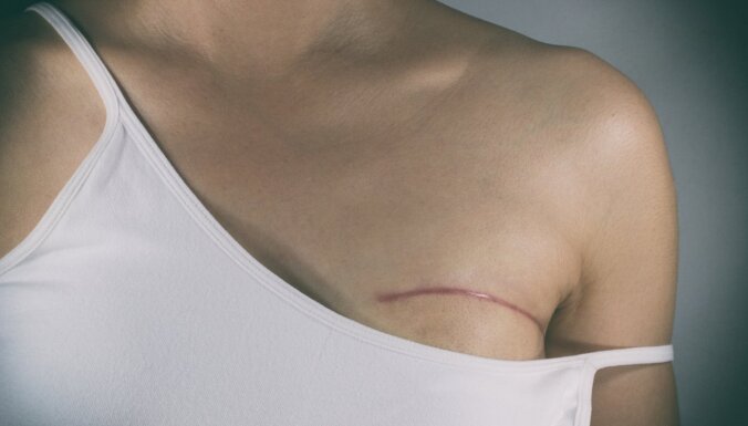 Krūts rekonstrukcija pēc mastektomijas – nepieciešamība, nevis iegriba